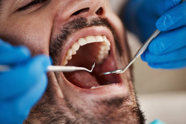 Dental Inlays and Onlays in The Hideout, PA